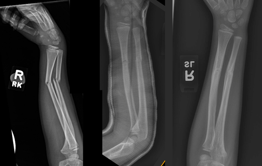 X-rays showing a 7-year-old with displaced radius and ulna fractures: injury, reduction and casting, and healed fracture