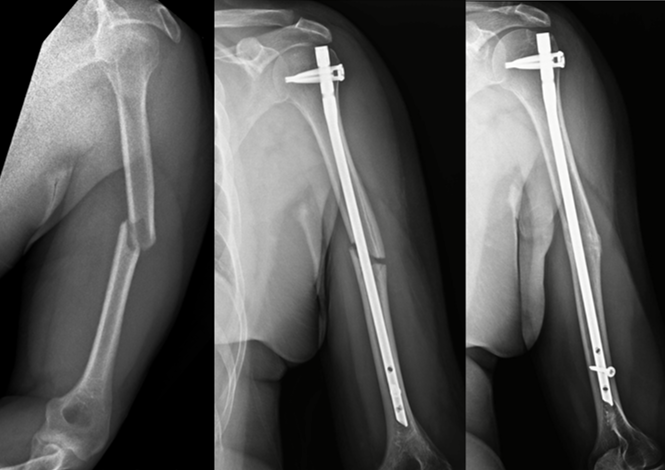 48 year old with unstable displaced humerus fracture
