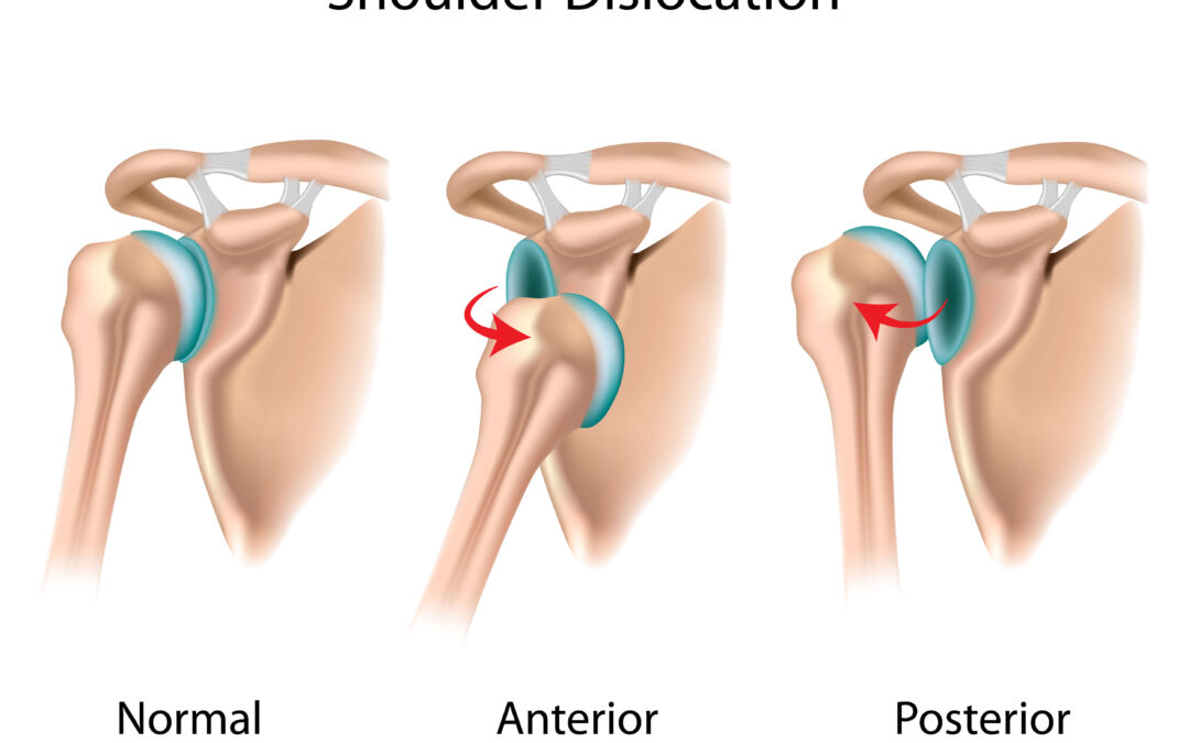 I Dislocated My Shoulder – Now What?