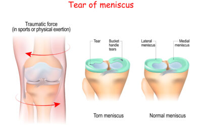 MENISCAL TEARS — Who Gets Them, and How to Manage Them