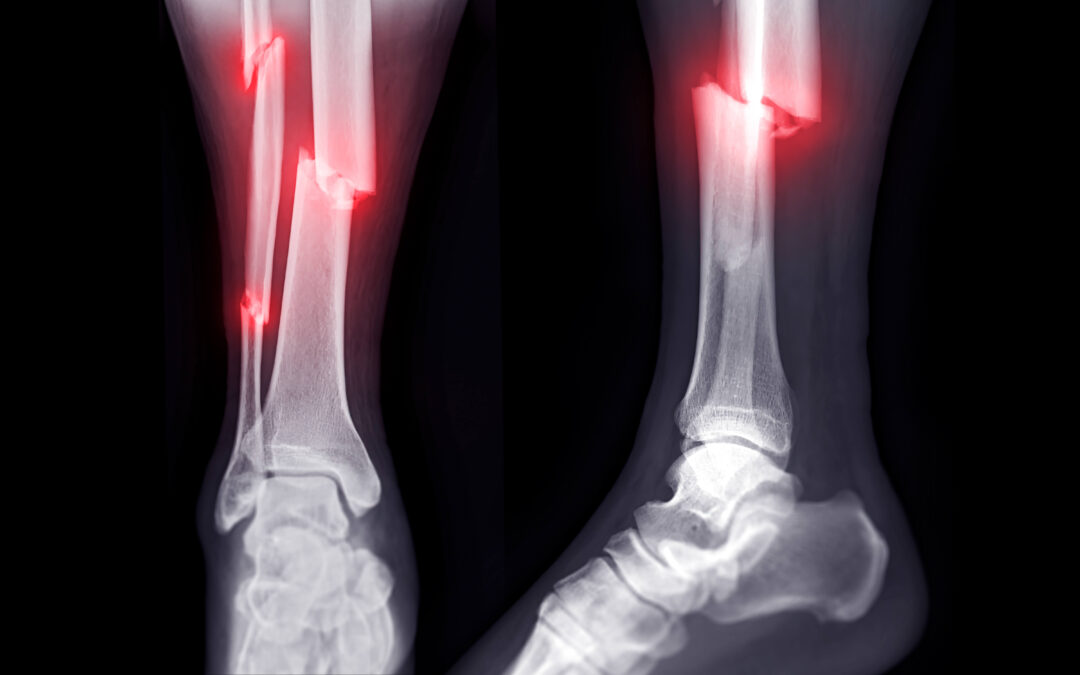 X-ray image of ankle joint showing fracture tibia and fibula bone