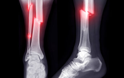 When Does a Fracture Require Surgery?