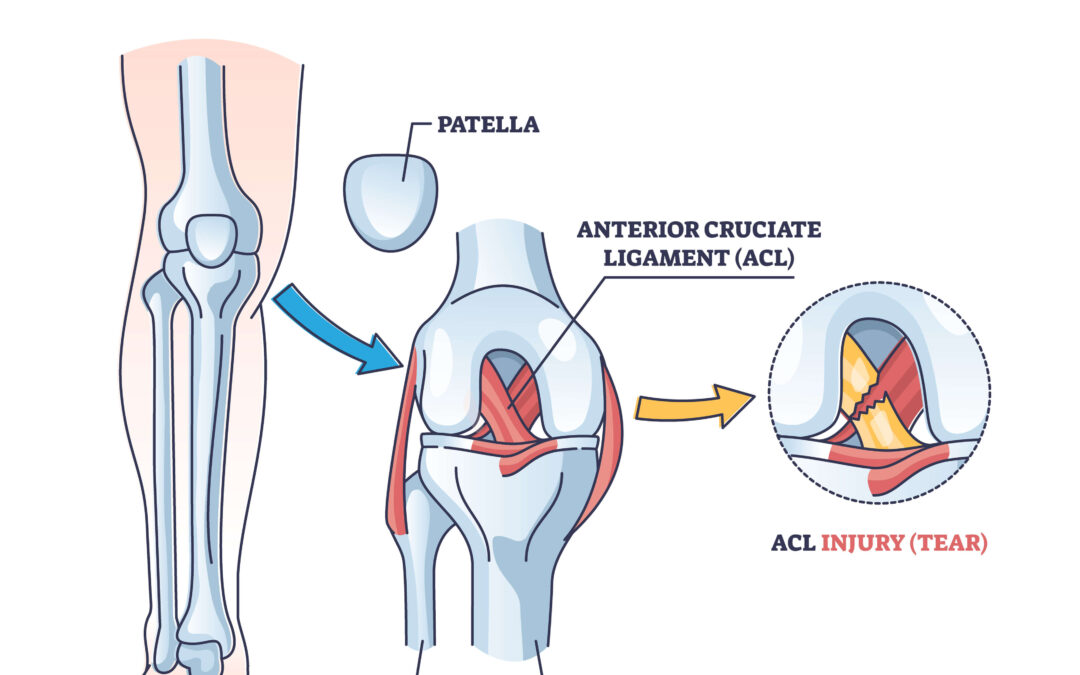 What is an ACL Injury?