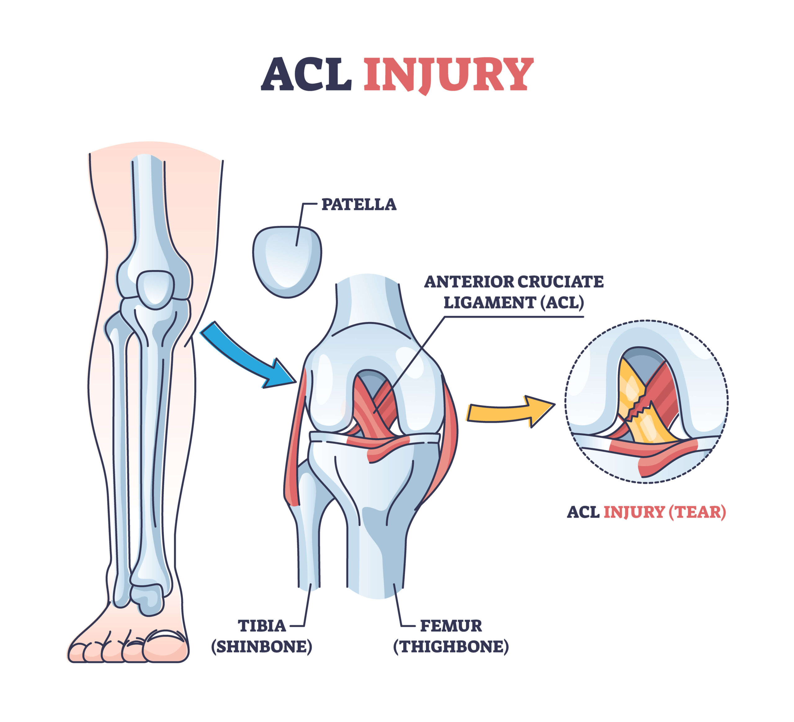 What is an ACL Injury?